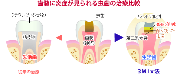 歯髄温存法（３Ｍｉｘ法）