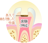 虫歯に侵された組織の除去