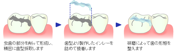 Ｃ２レベルの虫歯の治療例